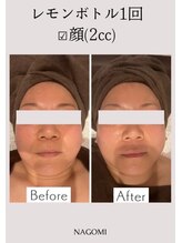 なごみ/脂肪分解【レモンボトル】