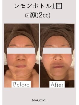 なごみ/脂肪分解【レモンボトル】