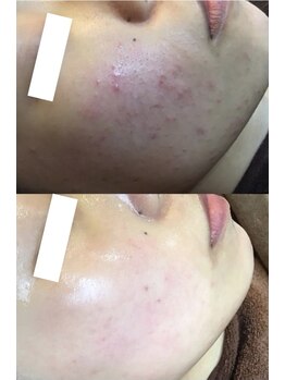 エヴァーグレース 河原町店/京都河原町の毛穴改善美肌サロン