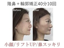 ラプリ 大阪心斎橋店(Raplit)/隆鼻＋輪郭矯正40分10回