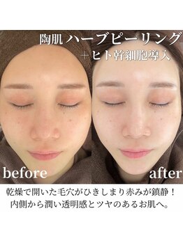 エムラボ 池袋店(M LABO)/ハーブピーリングヒト幹細胞導入