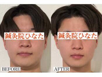 鍼灸院ひなた/むくみ/小顔/フェイスライン