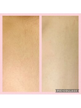 アンジェ(Ange)の写真/全身脱毛18000円