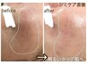 【秋のスポットシミケア×潤い管理】クリアを目指す★シミケア20分×水滴LDM