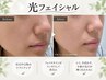 【２回目以降もお得に★】光フェイシャル10分 ￥1,650