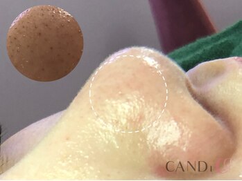 キャンディ 岐阜(CANDi)/ハイドラピーリング/黒ずみ毛穴