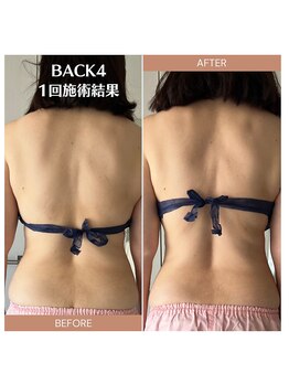 エステティックサロン やすらぎ心花(konoka)/BACK4施術1回で背中スッキリ!