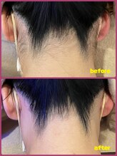 ミレボ(Me.rebo)/うなじ脱毛before→after