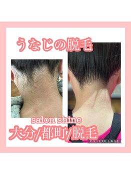 サロンシャイン(Salon Shine)/うなじ脱毛４０代女性