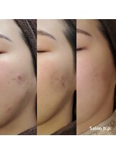 ビーピー 渋谷(b.p.)/ニキビケア　ハーブピーリング