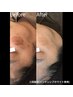 【紫外線対策・エイジングケア】シミ・シワ徹底改善コース　初回体験¥8,980