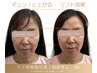 【8月限定リピ率90%以上】たるみ/浮腫み/小顔◎ ヒト幹細胞上清液原液1ml  