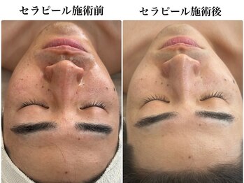 サプル(supple)/贅沢★美容鍼×最新ピーリング