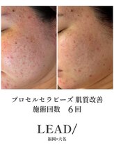 リードスラッシュ(LEAD/)/