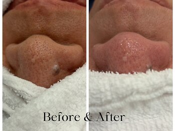 トウキョウビューティーラボ(TOKYO BEAUTY LABO.)/ハイドラBefore&After