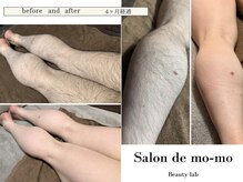サロンド モーモ(SALON de mo-mo)の雰囲気（最新ハイパワー脱毛器は太く強い毛にもしっかり効果があります！）