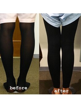 ホープ(HOPE)/◇O脚矯正