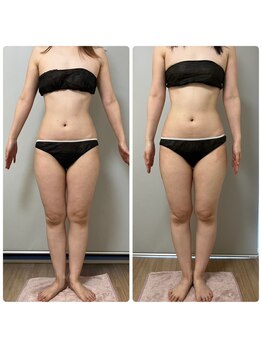 ジェニー(JENNI)/痩身+ヒートマット　施術1回