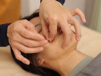 鍼灸院アゼ(AZE)の写真/【AZE式美顔鍼＋顔の歪み矯正】で顔のゆがみ、傾き、頬の張り、たるみ緩和◎ほうれい線にお悩みの方にも！