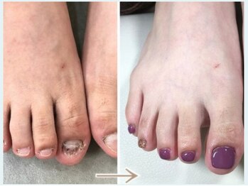 フット深爪ネイル