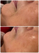 クレル(Clair)/70代　口元before→after