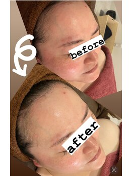 ロール(Rowl)/ハーブピーリング(酵素入り)