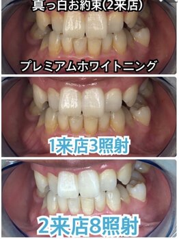 グレイスホワイトニング ヨコハマ(Grace Whitening Yokohama)/2来店8照射