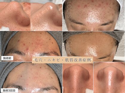 ルイス(LOUIS)の写真