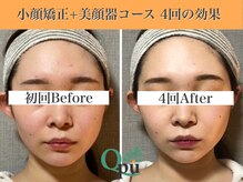 キュープ 表参道店(Qpu)/美顔器モニターコース4回の変化