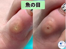 プラスワンフット 本厚木(+1 Foot)/本厚木で足の小指の魚の目をケア