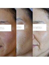 エトル(etole)/50代お客様症例写真