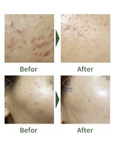 ひまわり/ハーブピーリング