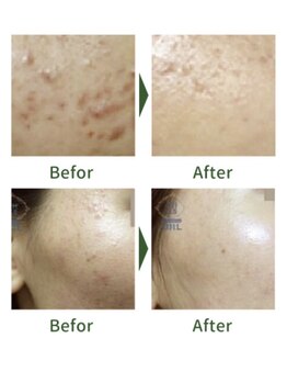 ひまわり/ハーブピーリング