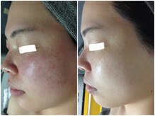 ルノン(LUNON)/ノーファンデ肌に