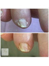 サロン アンド ルクス(Salon & Lux)/巻き爪ケア
