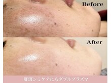 イリゼ(iriser)の雰囲気（エリア初のダブルプラズマは毛穴ニキビケアのほかにシミ改善も◎）