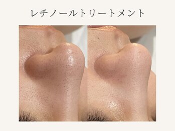 リノ(Lino)/ビフォーアフター