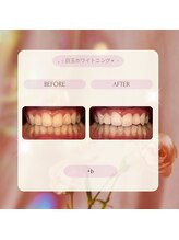 プラスビーセルフ(+b self)/ホワイトニングビフォーアフター