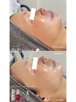 クレヴィー(Creviy)/陶肌ピール1回