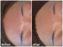 ボヌールデソワ(Bonheur de Soi)/ハーブピーリング　赤み軽減