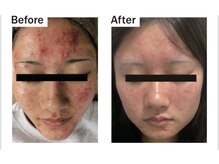 プラズマ +エレクトロポレーション　でここまで改善