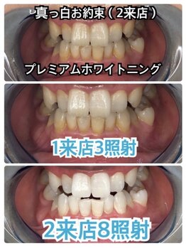 グレイスホワイトニング ヨコハマ(Grace Whitening Yokohama)/2来店8照射