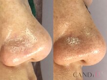 キャンディ 岐阜(CANDi)/ハイドラピーリング/黒ずみ毛穴