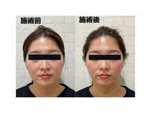 楽美身/左右差の改善