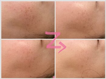 ヴィオラ(Viola)/ハーブピーリング4回での効果