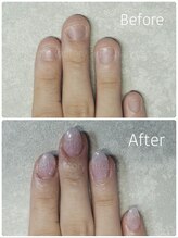 アウラ ネイル ファクトリー(aura nail factory)/深爪矯正スカルプ(長さだし)ラメ