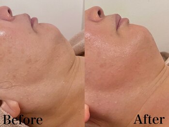 銀座ナチュラル スタイル (Natural Style)/ヴィーナスDIVA施術1回