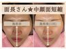 【中顔面短縮】全顔リフトアップフェイシャル　約40分　¥11,560→