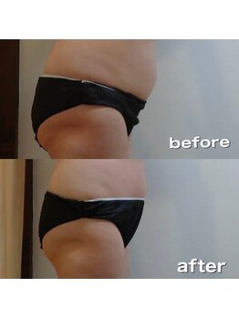 ロイヤルセラピスト 袋町店(Royal Therapist)/筋膜リリース