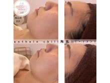 アンテイン チル(anthein chill)/陶肌トリートメント